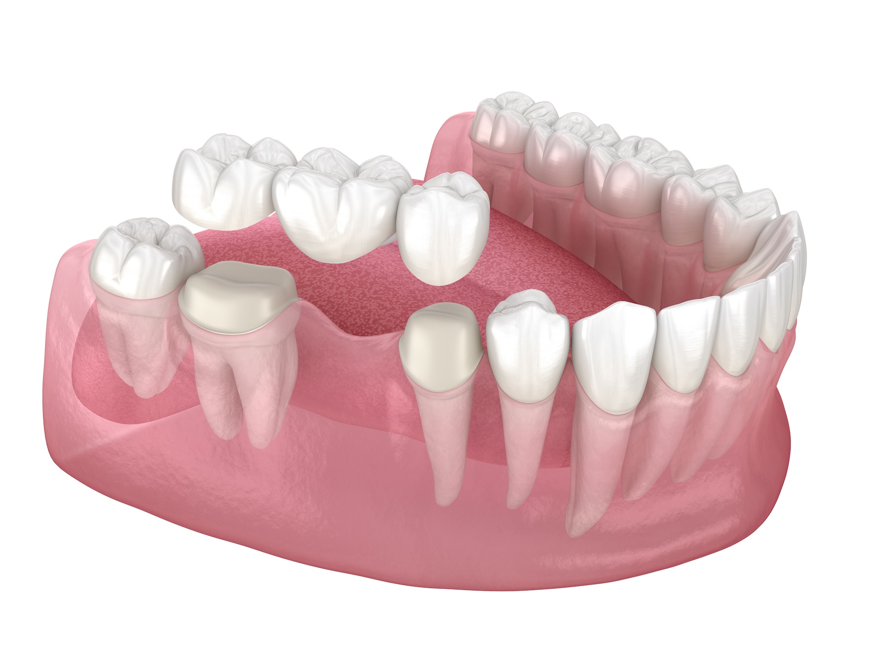 Dental bridge of 3 teeth over molar and premolar.