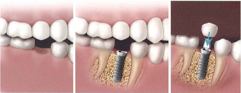 Dental-implants